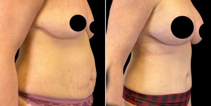 Abdominoplasty Marietta GA