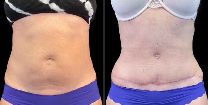 Front View Abdominoplasty Marietta