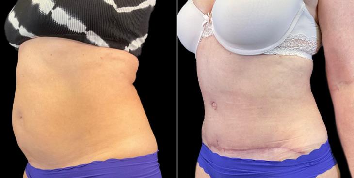 Side View Abdominoplasty Marietta