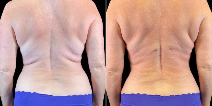 Abdominoplasty Marietta Back View