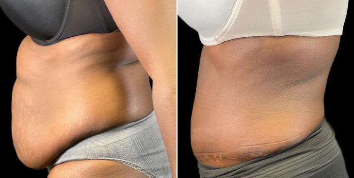 Tummy Tuck Results Cumming GA