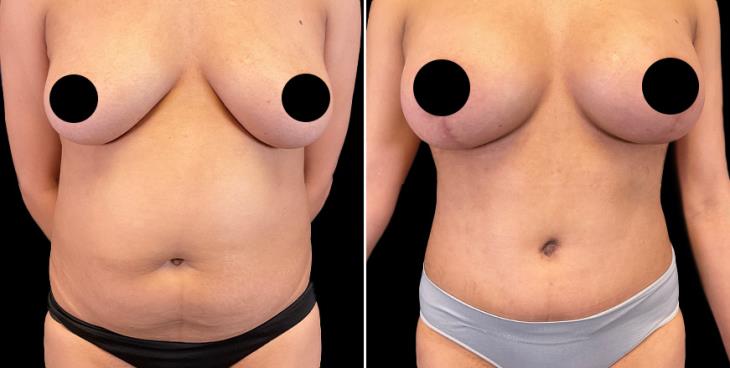 Cumming Tummy Tuck Results Front View