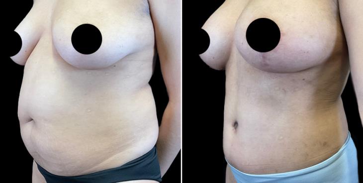 Side View Cumming Tummy Tuck Results