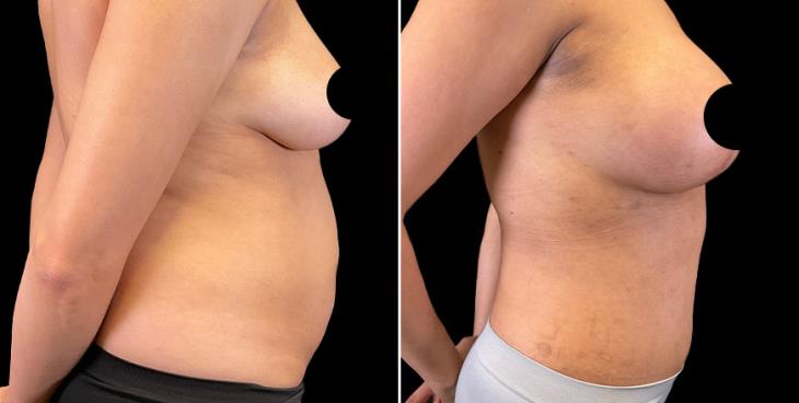Tummy Tuck Before And After Cumming