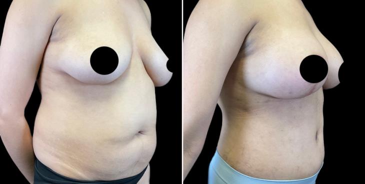 Before And After Tummy Tuck Cumming