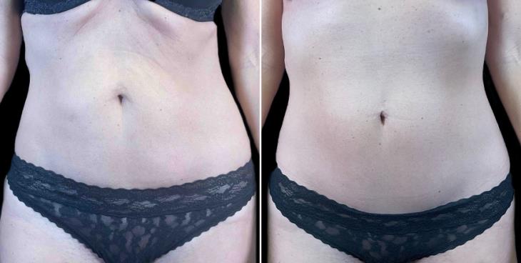 Before And After Reverse Tummy Tuck Atlanta