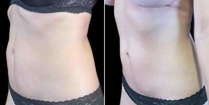 Upper Tummy Tuck Before And After Atlanta GA