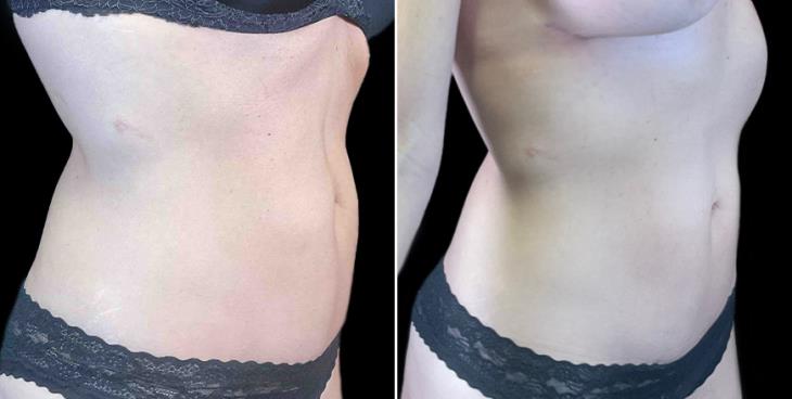 Reverse Tummy Tuck Before & After Atlanta GA