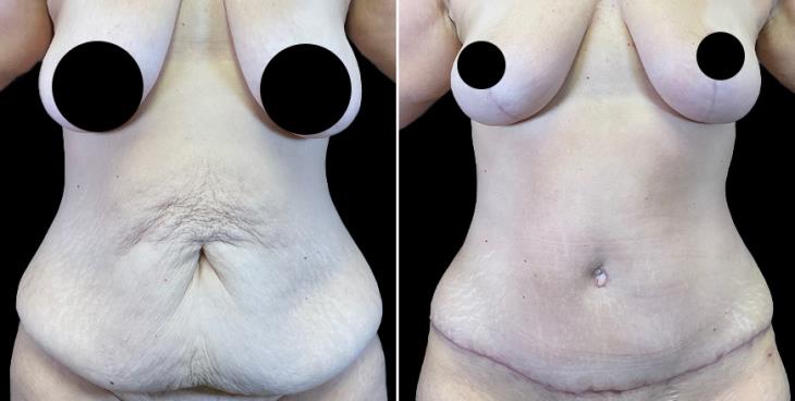 Before & After Tummy Tuck Cumming GA
