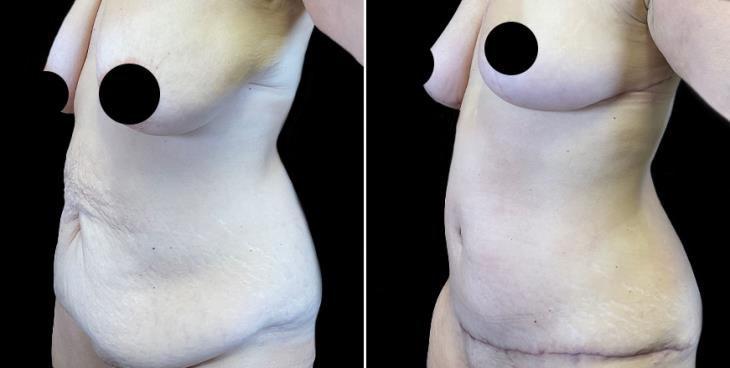 Before & After Tummy Tuck Cumming GA ¾ Front View