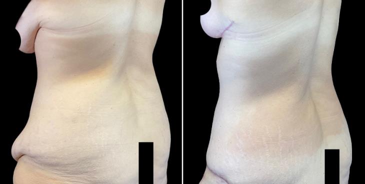 Before & After Tummy Tuck Cumming GA ¾ Back View