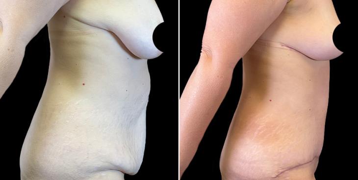 Before & After Cumming GA Breast Lift