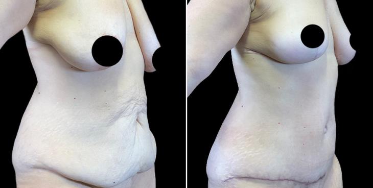 Cumming GA Breast Lift Before & After