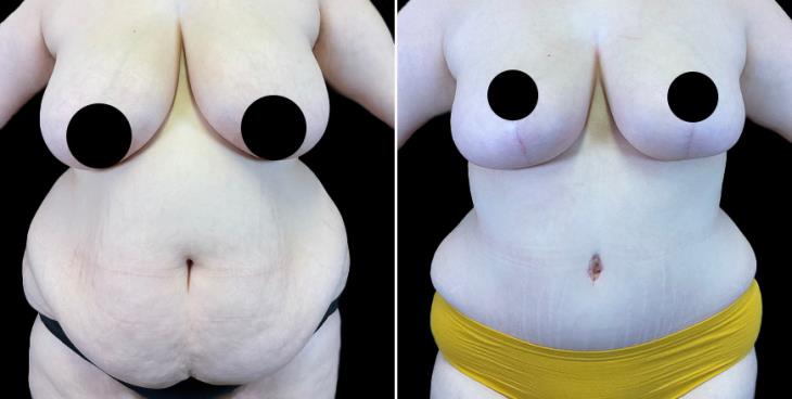 Cumming GA Results Of Abdominoplasty