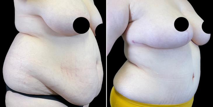 ¾ Cumming GA Abdominoplasty Results