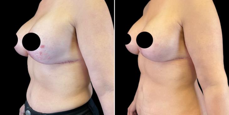 Breast Augmentation With Lift Side View