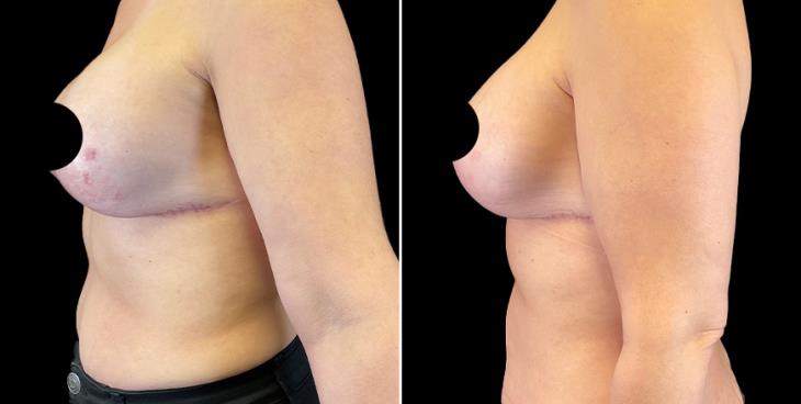 Breast Augmentation With Lift