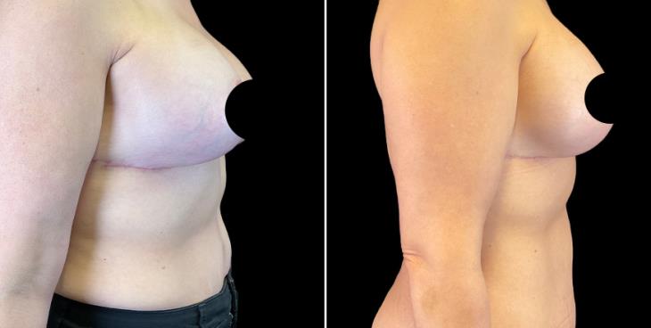 Breast Augmentation With Lift Results