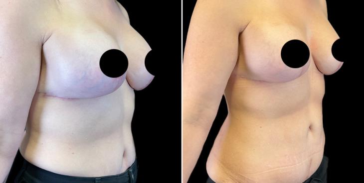 Side View Breast Augmentation With Lift