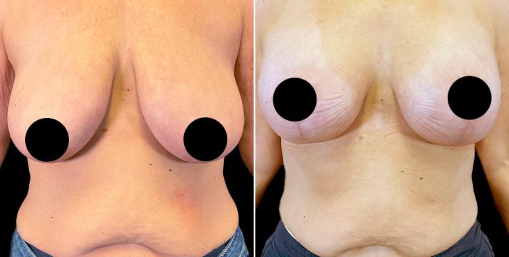Results Of Breast Augmentation With Lift