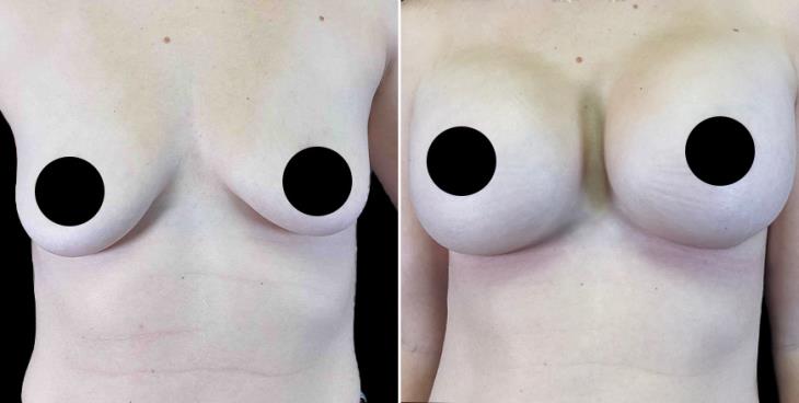 Georgia Breast Implants