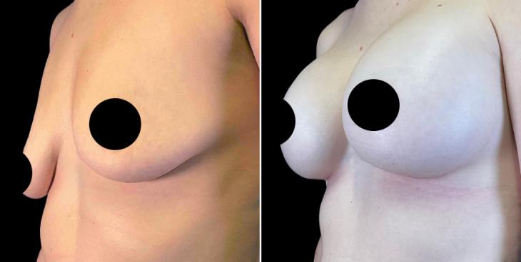 GA Breast Implants