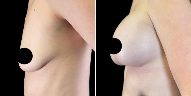 Breast Implants Georgia