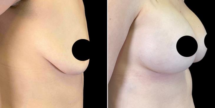 Breast Implants Marietta