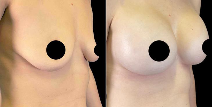 Breast Implants GA