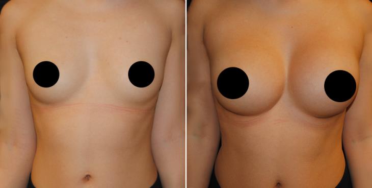 Marietta Breast Implants