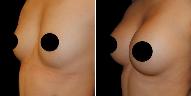 Marietta GA Breast Implants
