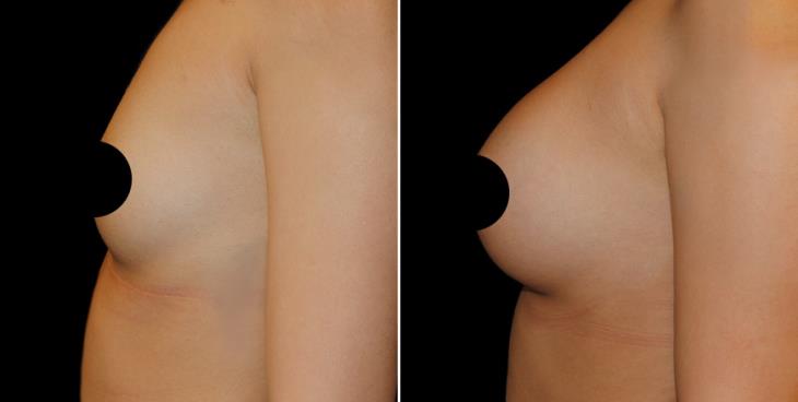 Breast Implants Marietta GA
