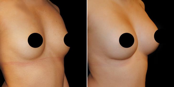 Breast Implants Cumming