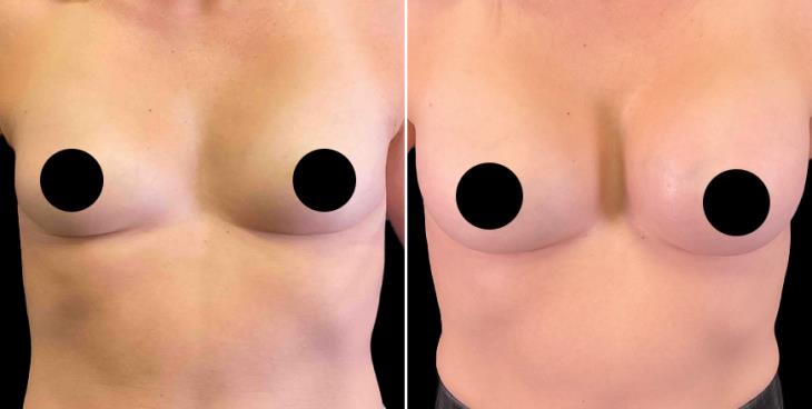 Breast Implants Cumming GA
