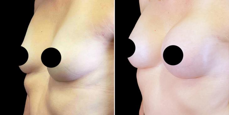 Breast Implant Results Cumming