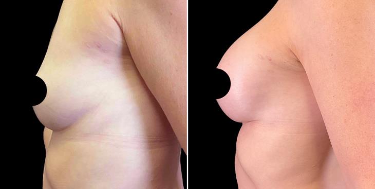 Cumming GA Breast Implants