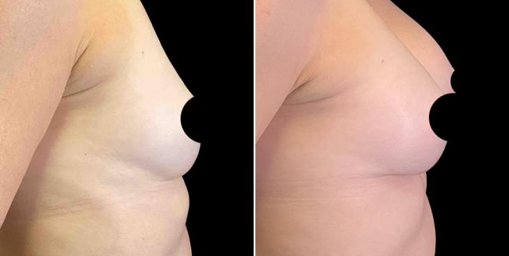 Breast Implant Results Cumming GA