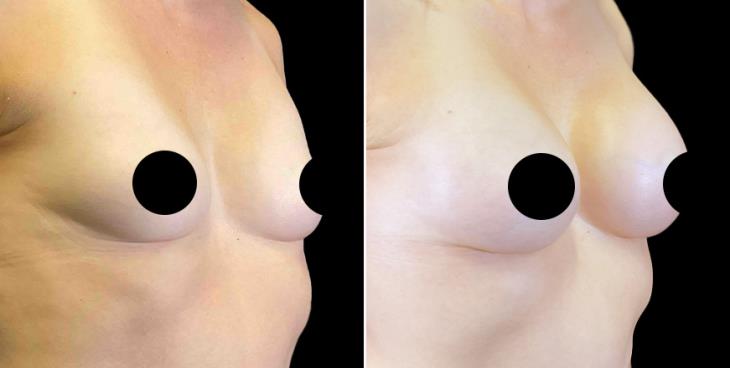 Cumming Breast Implant Results
