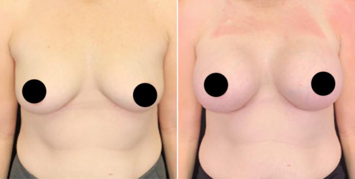 Cumming GA Breast Implant Results