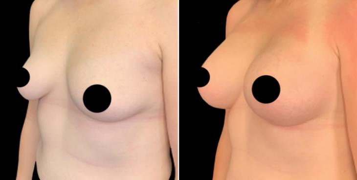 Breast Implant Results Cumming Georgia