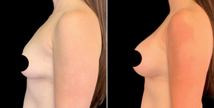 Cumming Georgia Breast Implant Results