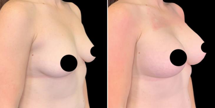 Breast Implant Results Marietta