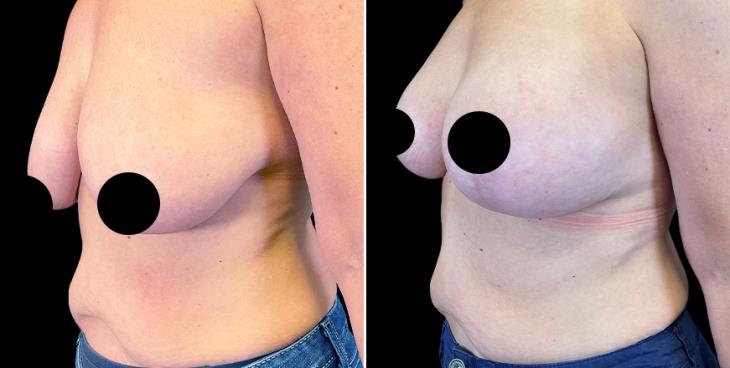 Breast Augmentation With Lift Results Atlanta