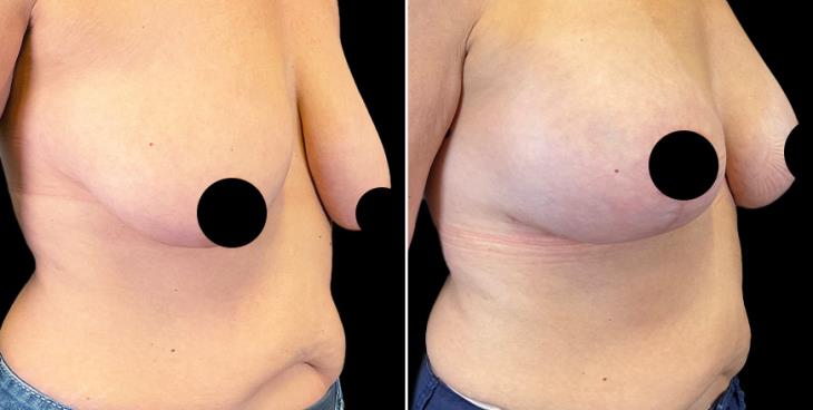 Atlanta Breast Augmentation With Lift Results