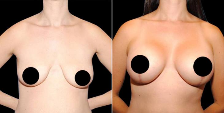 Before And After Breast Augmentation Georgia