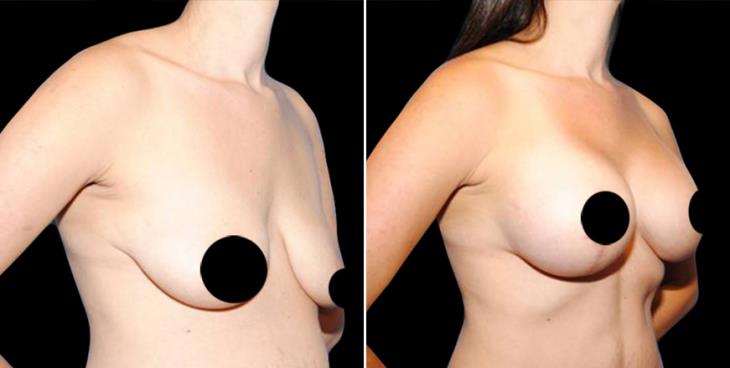 Before And After Breast Augmentation Georgia Side View