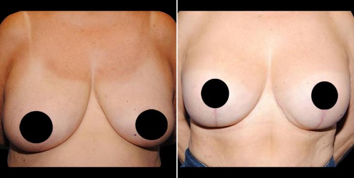 Georgia Breast Augmentation Before And After
