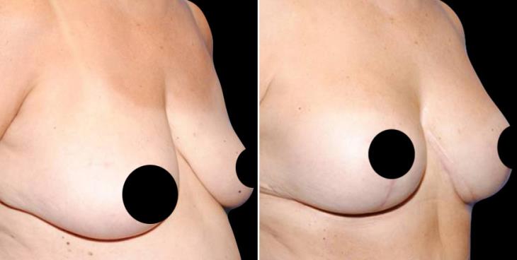 Georgia Breast Augmentation Before And After Side View