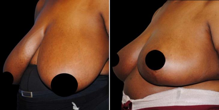 Before & After Breast Reduction Atlanta