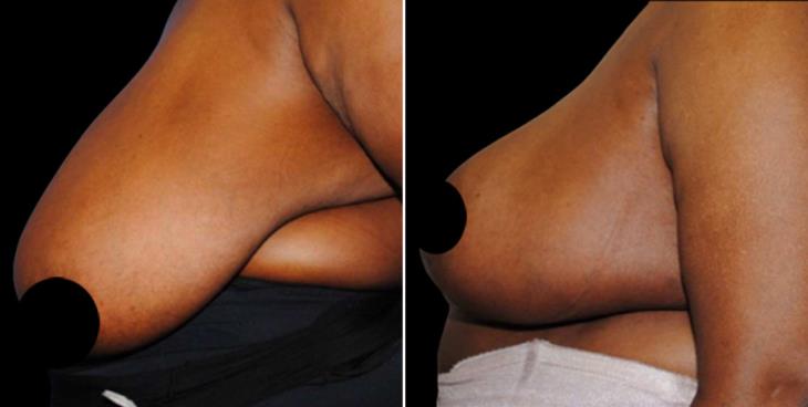 Before & After Breast Reduction Atlanta Side View